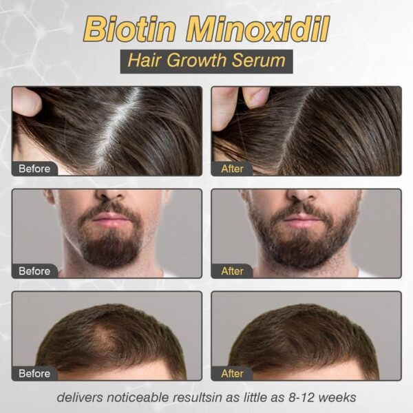 5% Minoxidil Hair Growth for Men and Women, Minoxidil Hair Growth Serum, Promotes Hair Growth, Strengthens Hair Follicles, Helps Prevent Hair Fall and Hair Loss - Image 7